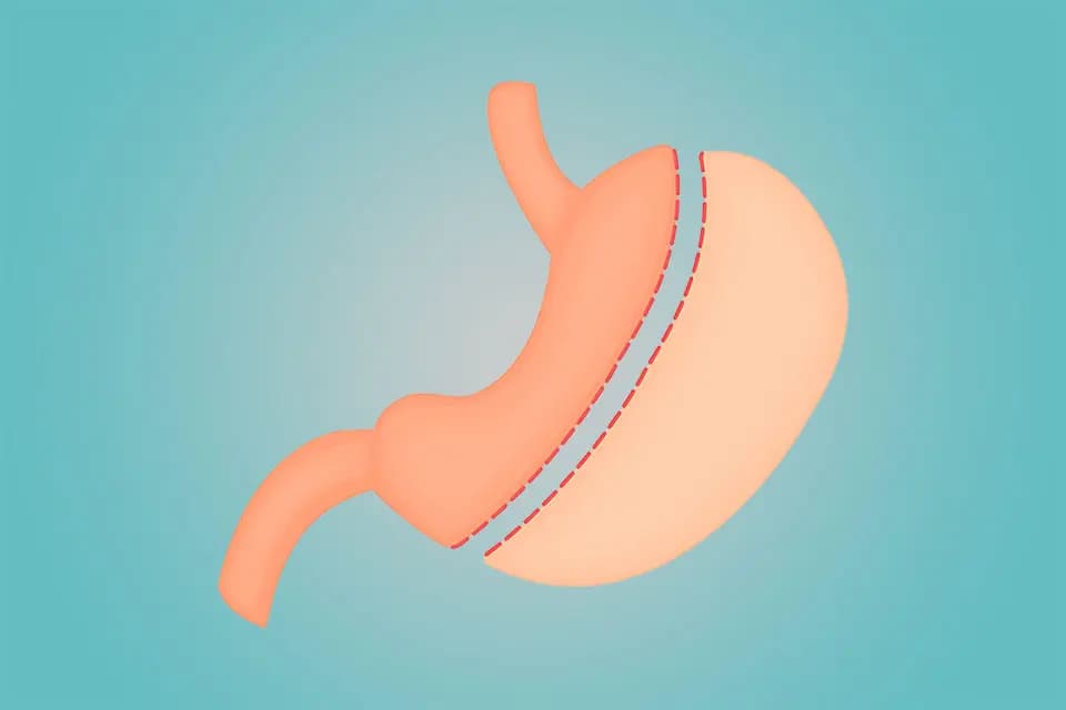 Gastric Sleeve Best Clinic Turkey – Transparent Prices and Quality Service